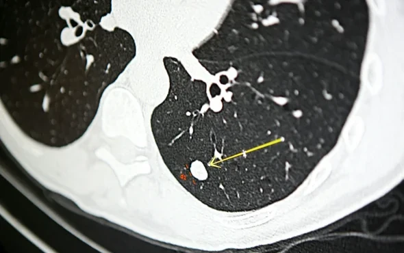 lung-cancer-screening
